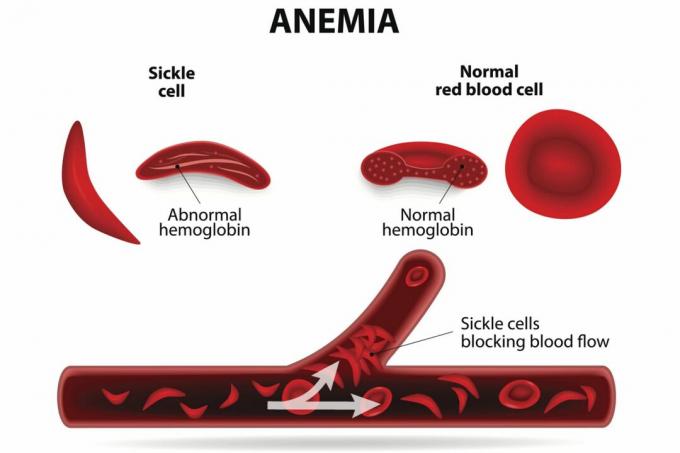 Sirppisoluanemia